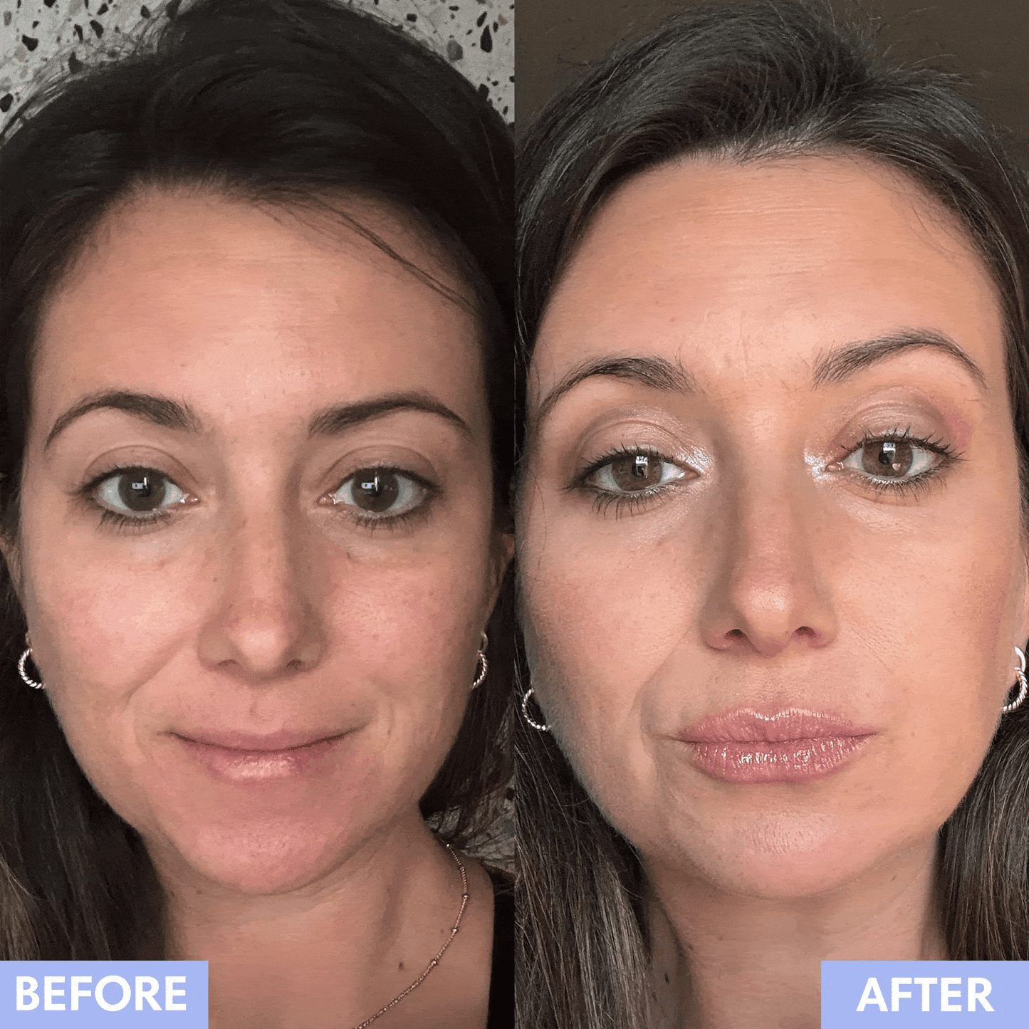 Lip Microinfusion Kit™