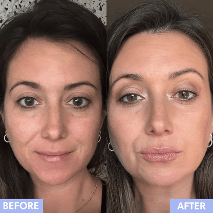 Lip Microinfusion Kit™